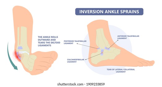 Ankle sprain with the ligament tear and injury