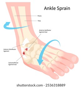 Ankle sprain with the ligament tear and injury