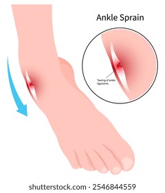 Lesão da entorse do tornozelo que causou dor no pé e inflamação dos ligamentos