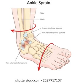 ankle sprain showing torn ligaments, anterior talofibular and calcaneofibular ligaments, injury mechanics diagram hand drawn schematic vector illustration. Medical science educational illustration