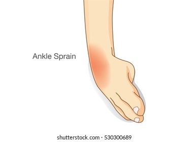 Ankle sprain and swelled. This illustration about common foot injuries.