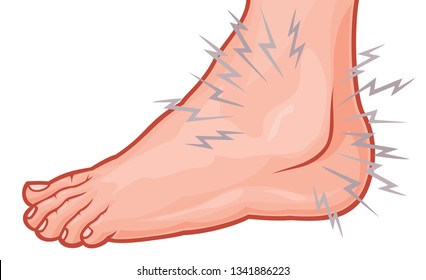 Ankle Sprain Vector Illustration