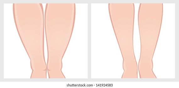 ankles before and after weight loss. Vector image on a white background. Scroll down to see more of my designs linked below.