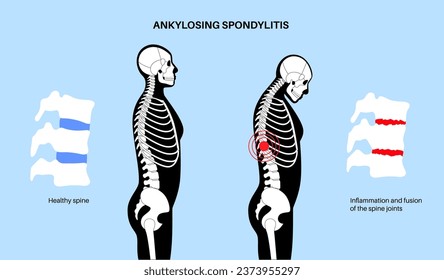 Ankylosing spondylitis. Arthritis that causes inflammation in the joints and ligaments of the spine. Inflamed and fusion vertebrae in the spinal column. Hip and lower back pain vector illustration