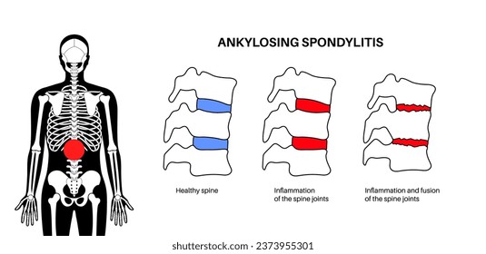 Espondilitis anquilosante. Artritis que causa inflamación en las articulaciones y ligamentos de la columna vertebral. Vértebras inflamadas y de fusión en la columna vertebral. Ilustración de vectores de dolor de cadera y espalda baja