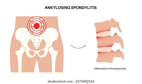 Ankylosing spondylitis. Arthritis that causes inflammation in the joints and ligaments of the spine. Inflamed and fusion vertebrae in the spinal column. Hip and lower back pain vector illustration