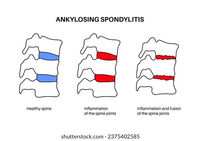 Espondilitis anquilosante. Artritis que causa inflamación en las articulaciones y ligamentos de la columna vertebral. Vértebras inflamadas y de fusión en la columna vertebral. Ilustración de vectores de dolor de cadera y espalda baja