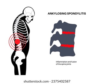 Ankylosing spondylitis. Arthritis that causes inflammation in the joints and ligaments of the spine. Inflamed and fusion vertebrae in the spinal column. Hip and lower back pain vector illustration