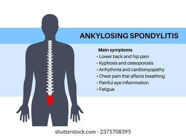 Espondilitis anquilosante. Artritis que causa inflamación en las articulaciones y ligamentos de la columna vertebral. Vértebras inflamadas y de fusión en la columna vertebral. Ilustración de vectores de dolor de cadera y espalda baja