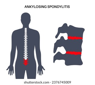 Ankylosing spondylitis. Arthritis that causes inflammation in the joints and ligaments of the spine. Inflamed and fusion vertebrae in the spinal column. Hip and lower back pain vector illustration