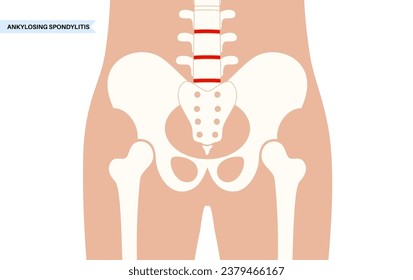Espondilitis anquilosante. Artritis que causa inflamación en las articulaciones y ligamentos de la columna vertebral. Vértebras inflamadas y de fusión en la columna vertebral. Ilustración de vectores de dolor de cadera y espalda baja