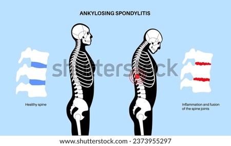 Ankylosing spondylitis. Arthritis that causes inflammation in the joints and ligaments of the spine. Inflamed and fusion vertebrae in the spinal column. Hip and lower back pain vector illustration