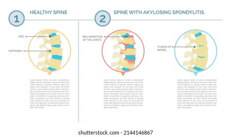 Ankylosing spondylitis and healthy spine infographic