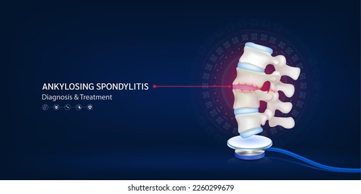 Ankylosing spondylitis, Human backbone disc cartilage model float away from stethoscope. Doctor diagnosis treatment. Medical technology innovation concept. Banner design for pharmacy clinic. 3d Vector