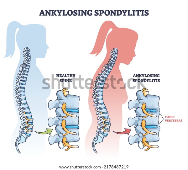 Ankylosing spondylitis as inflammatory spine bone\
disease outline diagram. Labeled educational anatomical comparison\
with healthy and damaged vertebrae vector illustration. Fused\
skeletal back\
parts.