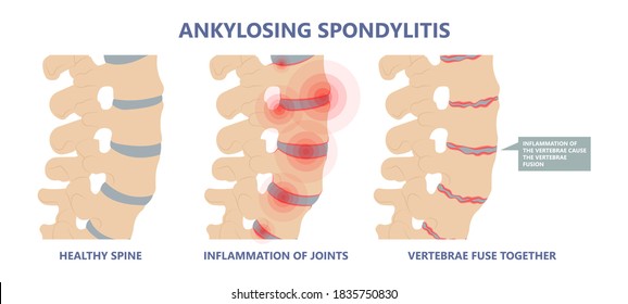 Ankylosing Spondylitis osteoporosis Skeletal pelvis Stiffness chronic knee ankle spondylolysis