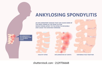 Ankylosing Spondylitis osteoporosis Skeletal pelvis Stiffness chronic knee ankle spondylolysis