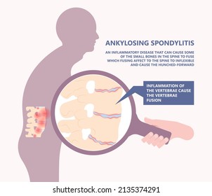 Ankylosing Spondylitis osteoporosis Skeletal pelvis Stiffness chronic knee ankle spondylolysis