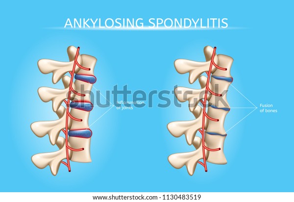 Ankylosing Spondylitis Realistic Vector Medical\
Chart with Human Vertebral Column Joints Inflammation and Bones\
Fusion Anatomical Illustration. Spine joint bones arthritis\
symptoms orthopedic\
concept