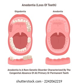 Anodontia. Rare genetic disorder characterized by the congenital absence of all primary or permanent teeth. Dental problem of missing tooth. Flat vector illustration