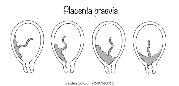 Anomalies in the location of the placenta, in which, being attached to the lower segment of the uterus, it partially or completely covers the internal os of the cervix. Isolated vector.