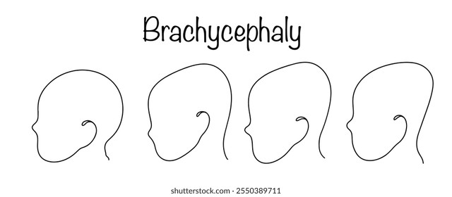 An anomaly in the structure of the skull, in which it is reduced in the anteroposterior direction. A drawing of the correct shape of a child's head and three options for gradual deformation.