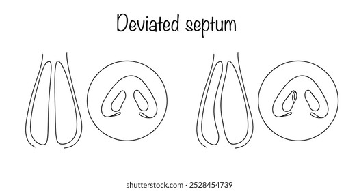 An anomaly, which is a deviation of the septum from its anatomically correct location. Drawn healthy septum and deviated nasal septum. A simple illustration for use in the medical field.