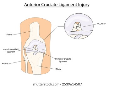 Ilustração do vetor de lesão do ligamento cruzado anterior (LCA)