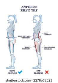Anterior pelvic tilt or APT as pelvis abnormal posture outline diagram. Labeled educational scheme with syndrome from increased lordosis of lumbar spine and protrusion of abdomen vector illustration.
