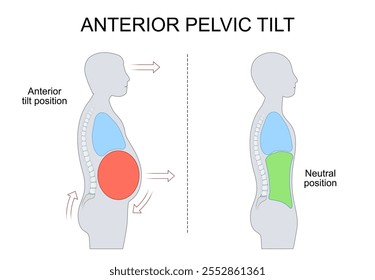 Inclinación pélvica anterior. Rotación pélvica. Lordosis lumbar. Desequilibrio postural. Debilidad del músculo abdominal. Dolor de espalda. Fisioterapia. Corrección pélvica. Biomecánica. Ilustración vectorial