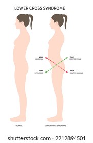 anterior pelvic tilt upper cross syndrome with trapezius and dowager’s painful spinal of Scheuermann's rounded Disk body poor Postural care