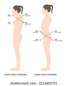 kyphosis torácica y postura de inclinación pélvica del cuerpo que conduce a síntomas dolorosos