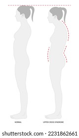 Concepto de mala y buena postura mientras se mantiene en pie comparado que lleva a síntomas de dolor de espalda