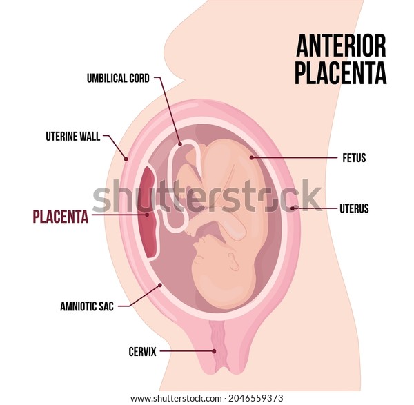 Anterior Placental previa. Usual anatomical\
Placenta Location During Pregnancy. Medical Pathology. detailed\
medical diagram with table of symbols. Colored vector illustration\
isolated on white.
