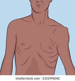 Anterior shoulder dislocation resulting from trauma or fall in young adults.