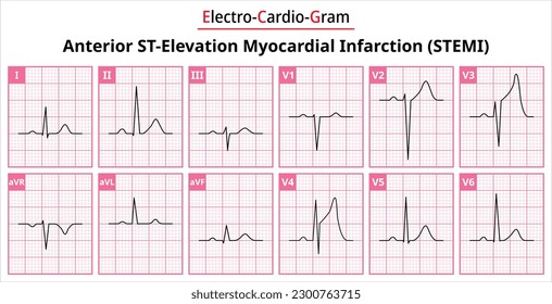 Anterior STEMI (ST-Elevation Myocardial Infarction) - The Differences in ECG Waveform for Each of the 12 Leads - Vectors and Illustrations for Medical Purposes