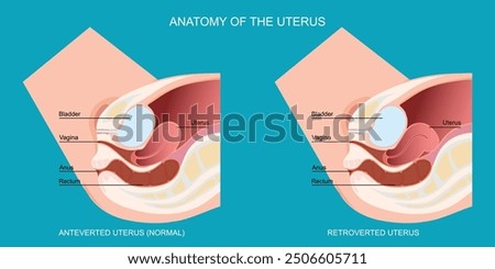 An anteverted uterus different than a retroverted uterus.Retroverted uterus, uterus tilts backward at the cervix.People with a retroverted can feel discomfort during sex and menstruation.