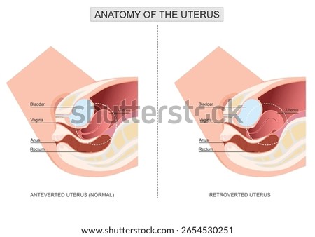 Anteverted uterus different than a retroverted uterus.Retroverted uterus, uterus tilts backward at the cervix.People with a retroverted can feel discomfort during sex and menstruation.