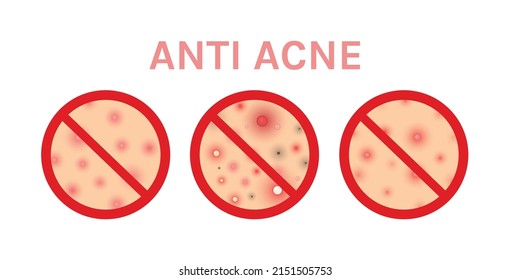 Anti Acne. Pimples and a Sign of Prohibition. Close Up of Acne. Problem Skin and Blackheads. Zoom. Color and Realistic style. White background. Illustration for Beauty and Medical design. Vector.