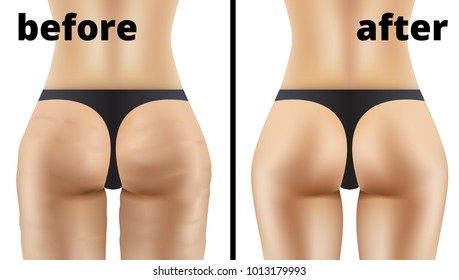 Anticellulite Ass Massage Before And After Illustration. EPS10 Vector