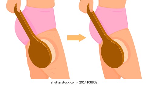 Masaje anticelulitis con cepillo. Deshágase de la celulitis en los muslos. El cuidado corporal y el concepto de belleza. Ilustración vectorial.