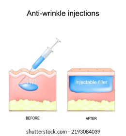 Anti-wrinkle injections. aesthetic procedure. rejuvenate the skin without surgery. Human skin with facial wrinkles before and after filler injected. syringe with hyaluronic acids, collagens