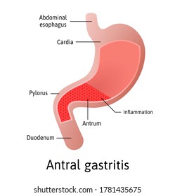 Antral Location of Gastritis, an inflammation of the lining of the stomach. Three types Antral, of the body and pangastritis. Medical vector illustration marked with lines. All parts of stomach. 