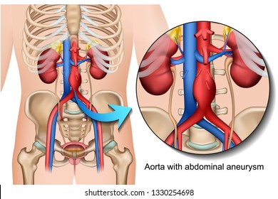 Aortic abdominal aneurysm 3d medical vector illustration isolated on white background
