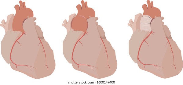 Aortic Aneurysm Repair Of Ascending Aorta Vector Illustration