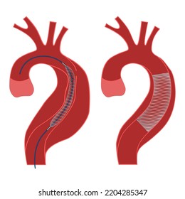 Aortic Aneurysm Aortic Stenting Diagram Stages Stock Vector (Royalty ...