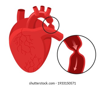 Aortic coarctation - aorta narrowing where the ductus arteriosus . Vector illustration