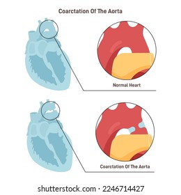 Aortic coarctation. Birth defect in which a part of the aorta narrowing where the ductus arteriosus. Flat vector illustration