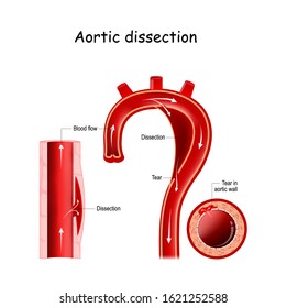 Aortic dissection. injury to the innermost layer of the aorta. blood to flow between the layers of the aortic wall. aortic arch. longitudinal and cross-section of blood vessel. vector illustration