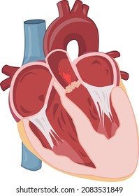 Aortic Stenosis With Left Ventricle Hypertrophy LVH Illustration